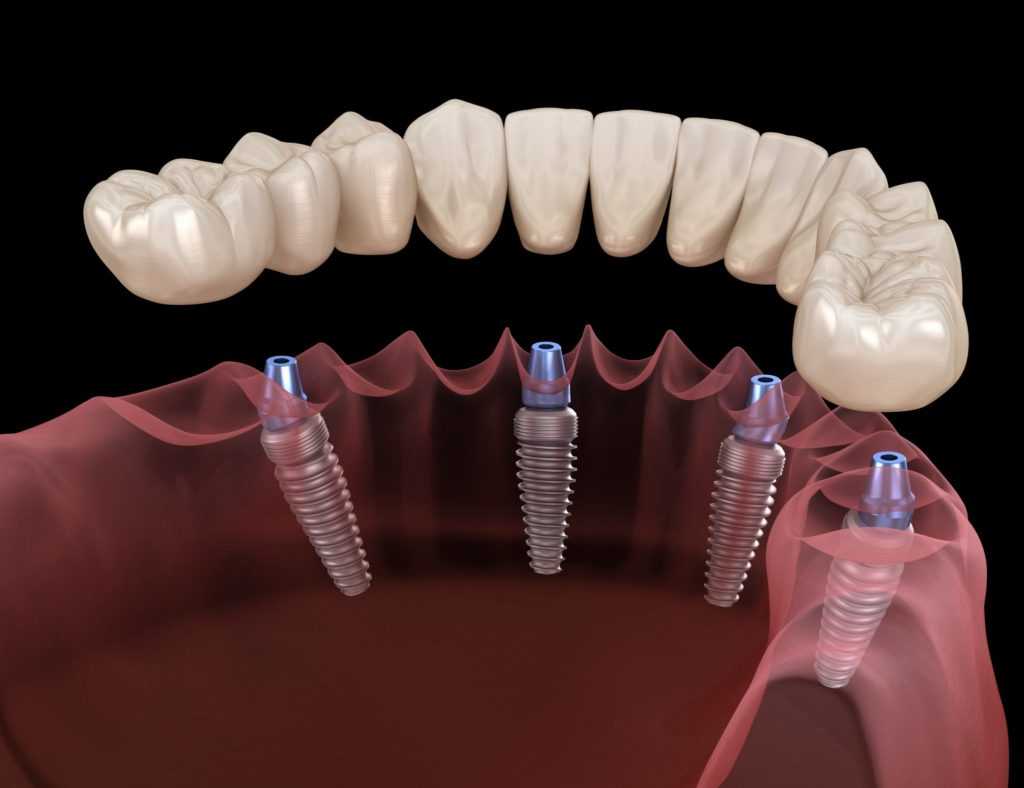 Протезирование зубов при пародонтите: какие протезы лучше, фото до и после, цены, отзывы