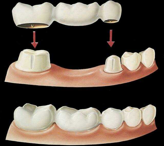 Материалы для протезирования зубов | сеть стоматологических клиник зуб.ру