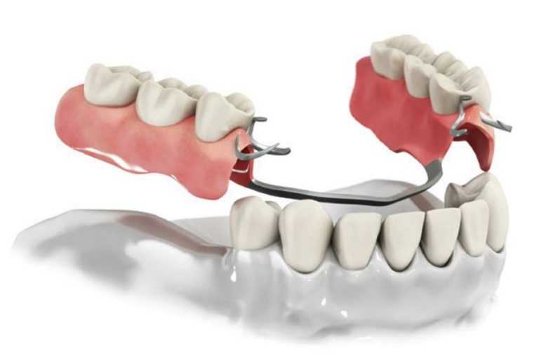 Мостовидные протезы зубов: виды протезов, материалы и этапы протезирования