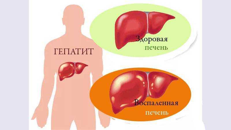 Гепатит с: пути заражения, диагностика, способы лечения