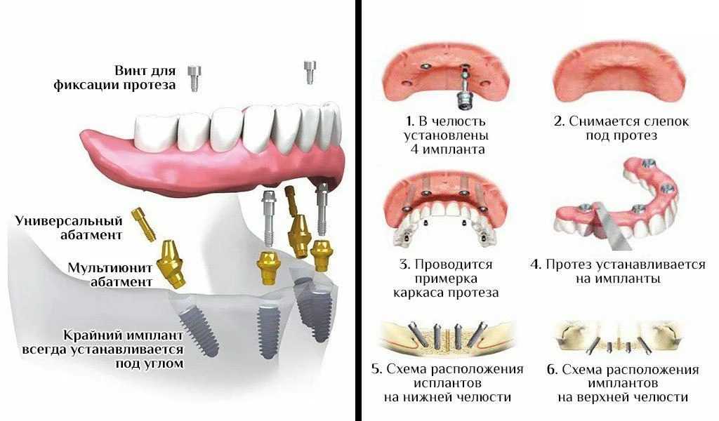 Протезирование зубов: показания, подготовка и порядок процедуры