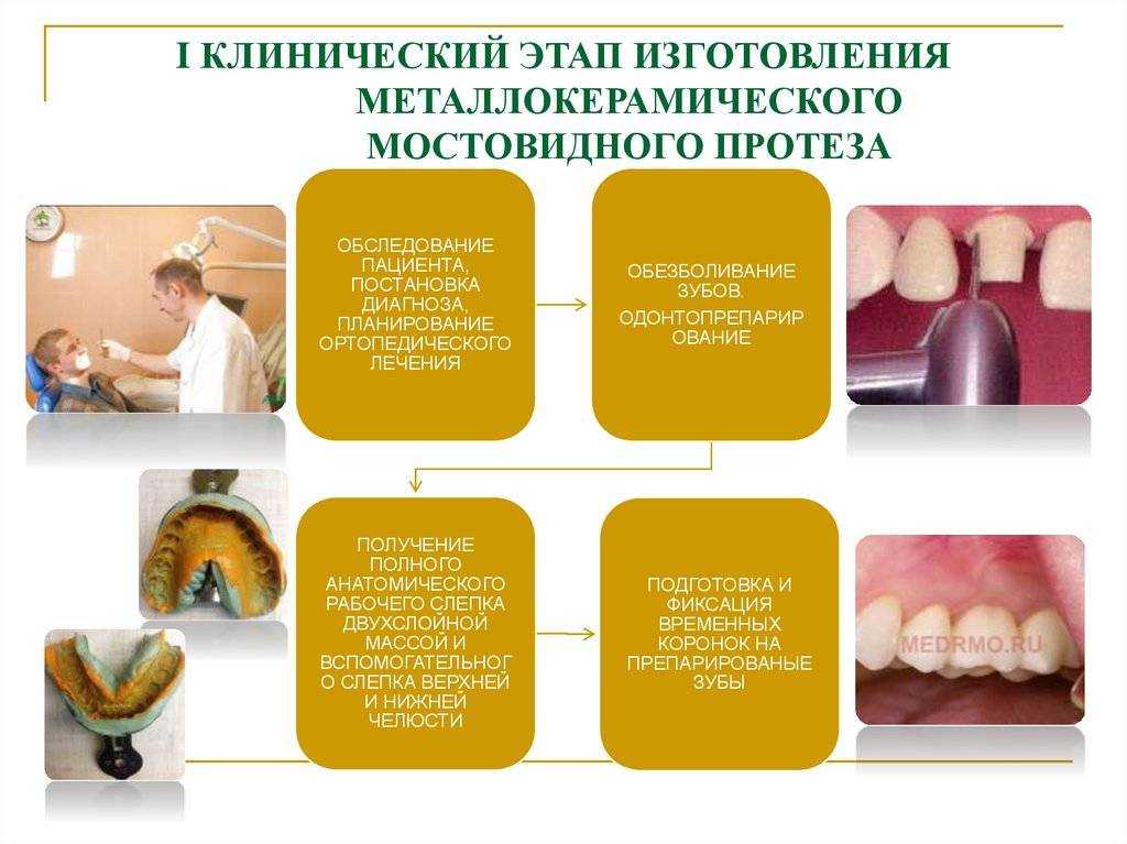 Частичный съёмный зубной протез. сравнение и обзор видов и цен