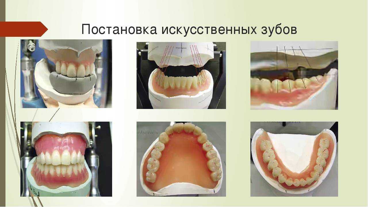 Несъемные зубные протезы: виды, цены и особенности несъемных зубных протезов