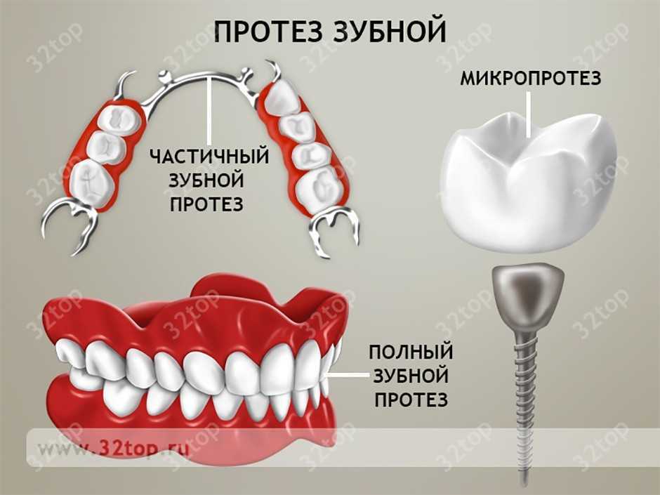 Частичный съёмный протез зубов
